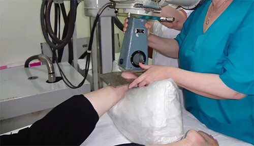 лучевая терапия (рентгенотерапия) пяточной шпоры. рентгенотерапия пяточной шпоры в спб. рентгенотерапия пяточной шпоры в спб. короткофокусная (близкофокусная) рентгенотерапия. ударно-волновая терапия (увт) пяточной шпоры.