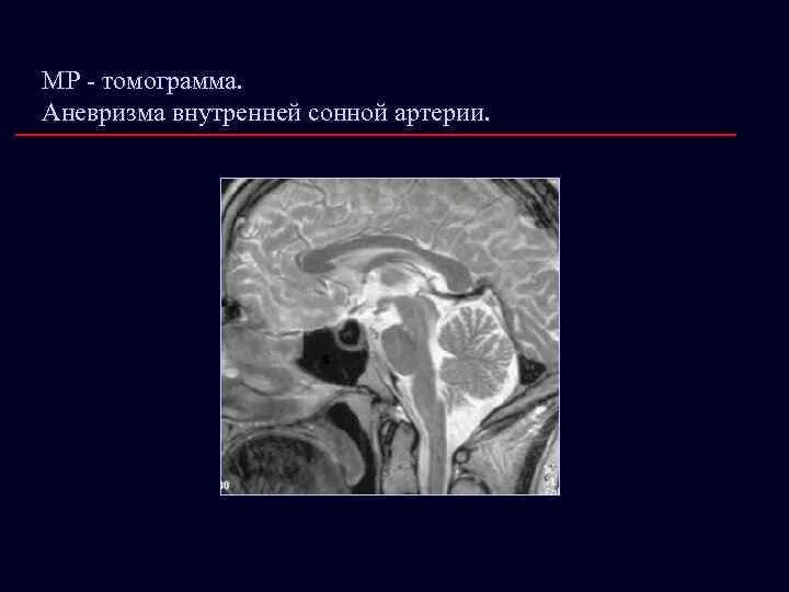 Мешотчатая аневризма внутренней. Мешотчатая аневризма вса. аневризма кавернозного сегмента вса. аневризма гипофизарной артерии. аневризма внутренней сонной артерии.