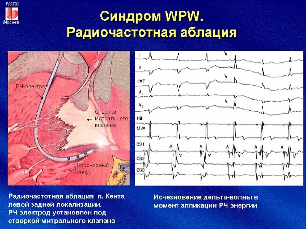 Катетерная абляция синдрома wpw. Операция при синдроме ВПВ. Операция при синдроме wpw. Латентный ВПВ синдром.