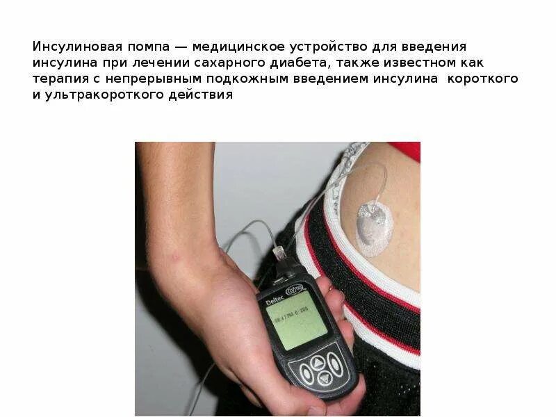 Инструкция инсулиновой помпы