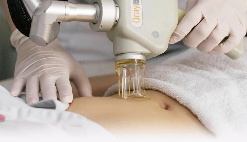 лазерное шлифование растяжек. лазерная терапия от растяжек. лазерный пилинг растяжек. лазерная шлифовка стрий. микродермабразия растяжек.