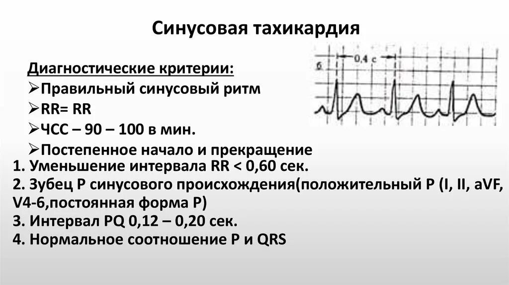 Учащенное сердцебиение при нагрузках. Синусовая тахикардия ЭКГ признаки. ЭКГ тахикардия синусовый ритм ЧСС 90. ЭКГ критерии синусовой тахикардии. Синусовая тахикардия на ЭКГ.