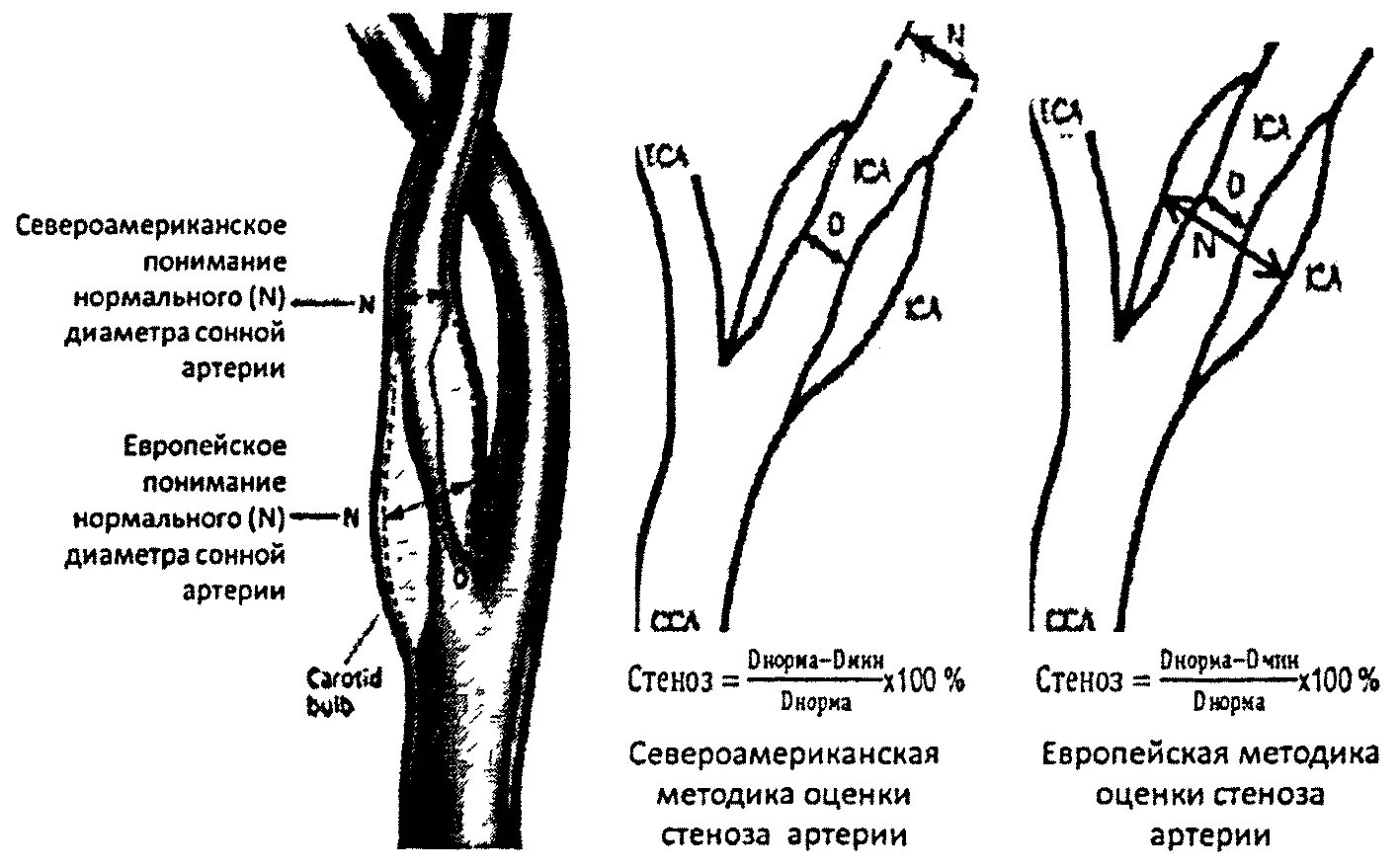 Процент стеноза сосудов. Сегмент м1 сонной артерии схема. Классификация стенозов сонных артерий. Отделы общей сонной артерии на УЗИ. Степени стеноза артерий нижних конечностей.