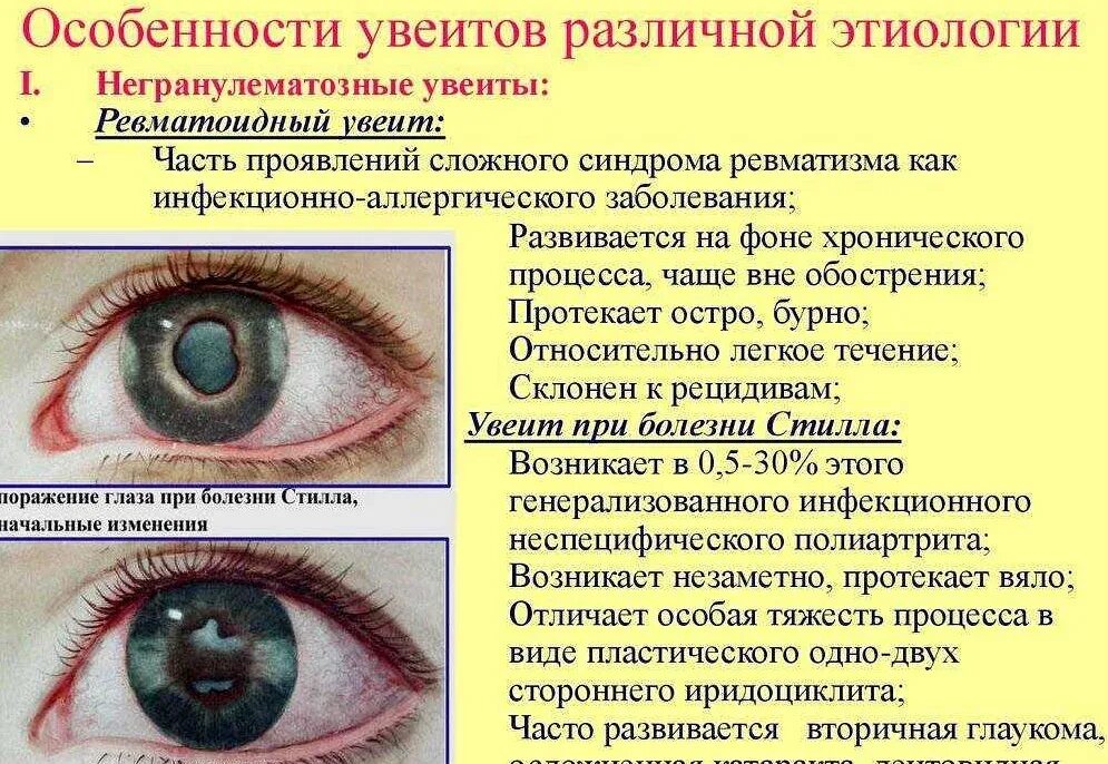 Увеит (воспаление сосудистой оболочки глаза).. Склерит , Ирит , кератит, иридоциклит.