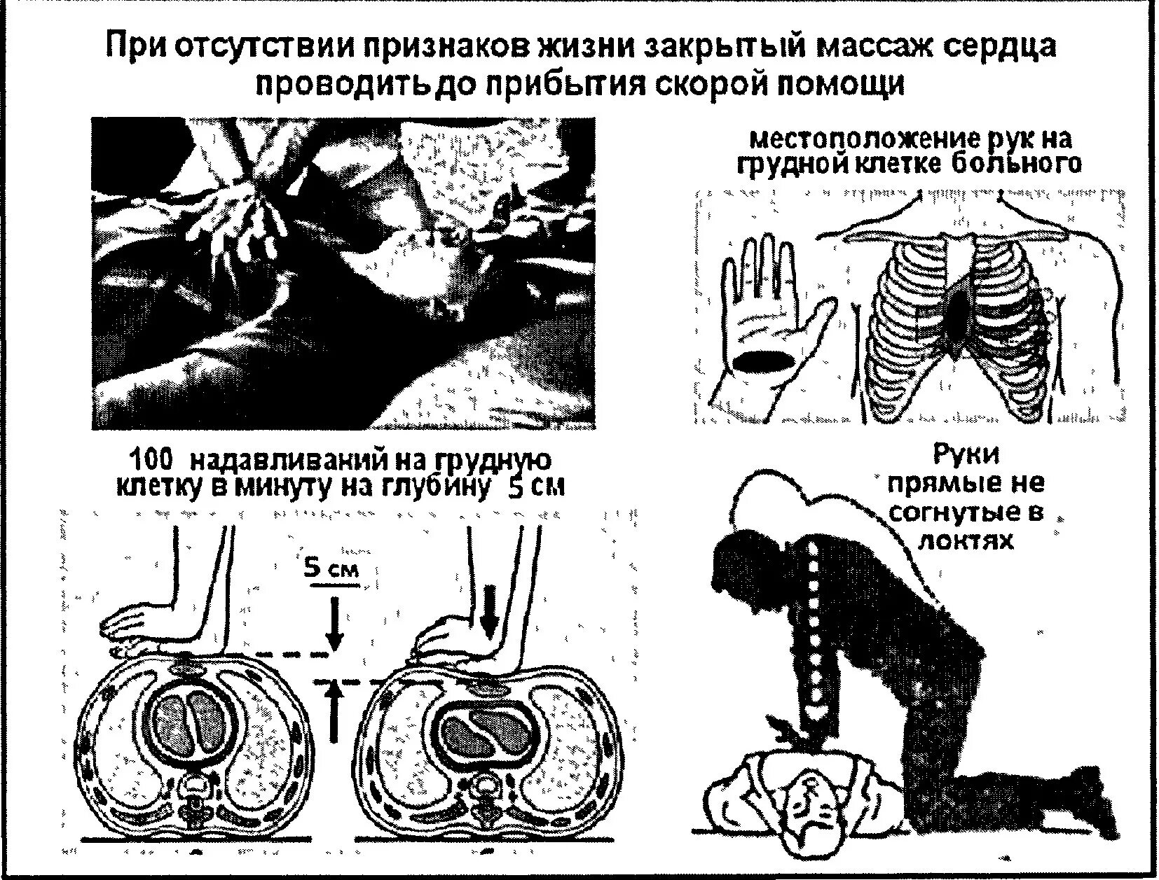 Алгоритм оказания первой помощи при внезапной смерти. Этапы оказания 1 помощи при внезапной смерти. Закрытый массаж сердца. Закрытый массаж сердца алгоритм. Частота закрытого массажа сердца