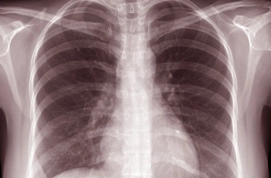 Легкие увеличен узел. Туберкулез внутригрудных узлов рентген. Туберкулез внутригрудных лимфоузлов инфильтративная форма. Инфильтративный бронхоаденит рентген.