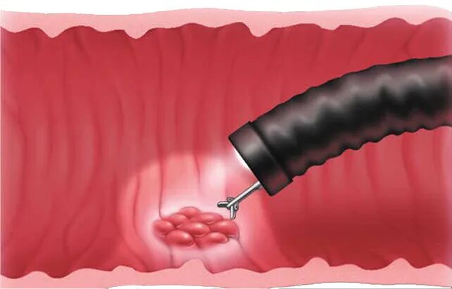Биопсия слизистой оболочки тонкой кишки. Биопсия желудка на цитологию. Колоноскопия кишечника полипы. Биопсия язвы