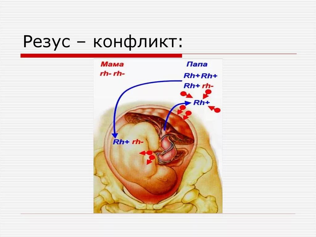 Резус конфликт. Резус конфликт презентация. Водянка плода при резус-конфликте. Резус конфликт картинки. Резус конфликтной