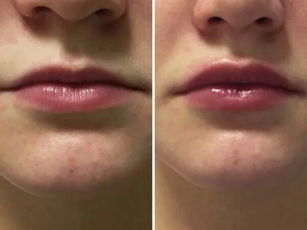 Филлер Ювидерм в губы 1 мл до и после. Губы Ювидерм до и после 0.5 0.5. 0.5 в губы до и после фото