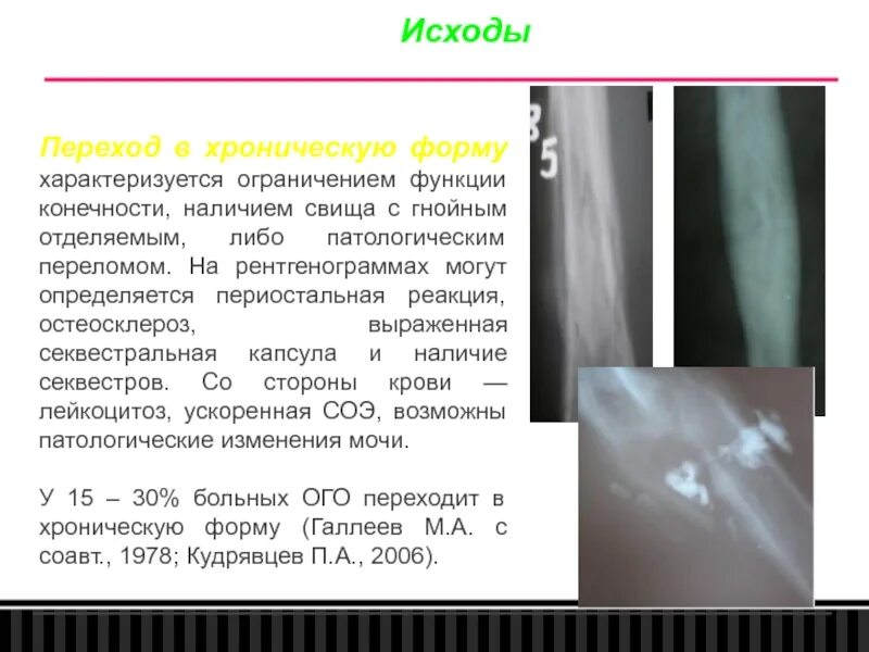 Переход заболевания в хроническую форму. Остеомиелит периостальная реакция. Хронический остеомиелит секвестр. Исходы хронического остеомиелита.