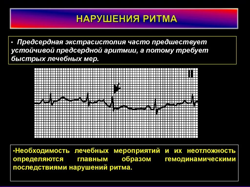 Эктопический предсердный ритм на ЭКГ. Нарушение ритма предсердная экстрасистолия. Предсердная экстрасистолия патофизиология. Блокированная предсердная экстрасистолия и АВ блокада. Эктопический предсердный ритм что это