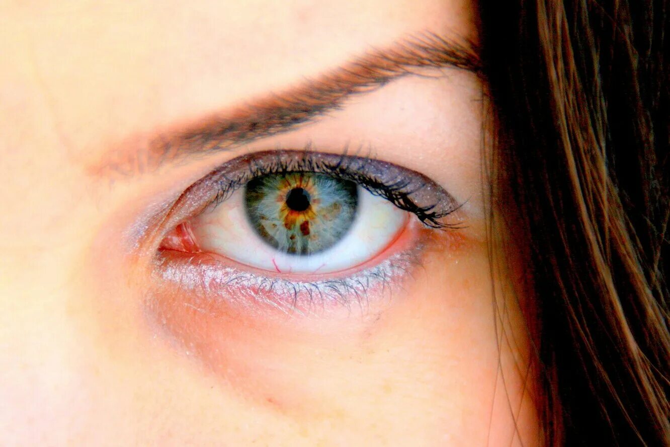 Другой голубой. Секторальная гетерохромия. Гетерохромия карих глаз. Цветные линзы гетерохромия. Неполная гетерохромия глаз.