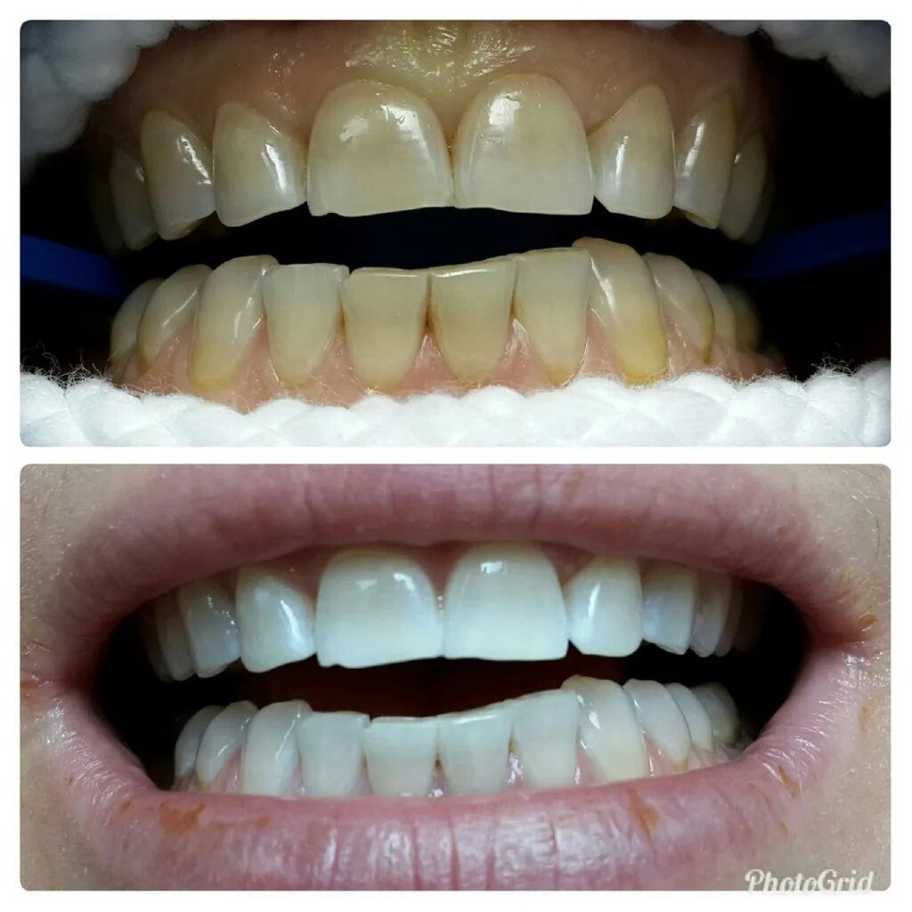 профессиональная чистка зубов до и после. зубы после отбеливания отзывы. проф отбеливание зубов до после. зубы после отбеливания отзывы. зубы до и после отбеливания.