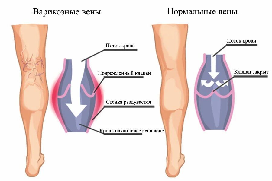 Гудят колени причины. Варикозное расширение вен на ногах. Варикозное расширение вен нижних конечностей классификация. Варикозная болезнь вен нижних конечностей. Массаж при варикозном расширении вен нижних конечностей методика.