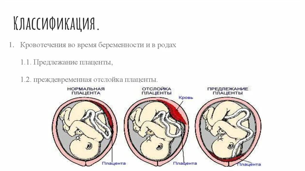 Отслойка плаценты кровотечение. Предлежание и отслойка плаценты. Предлежание плаценты родоразрешение Акушерство. Срок беременности при предлежании плаценты. Роды 18 недель