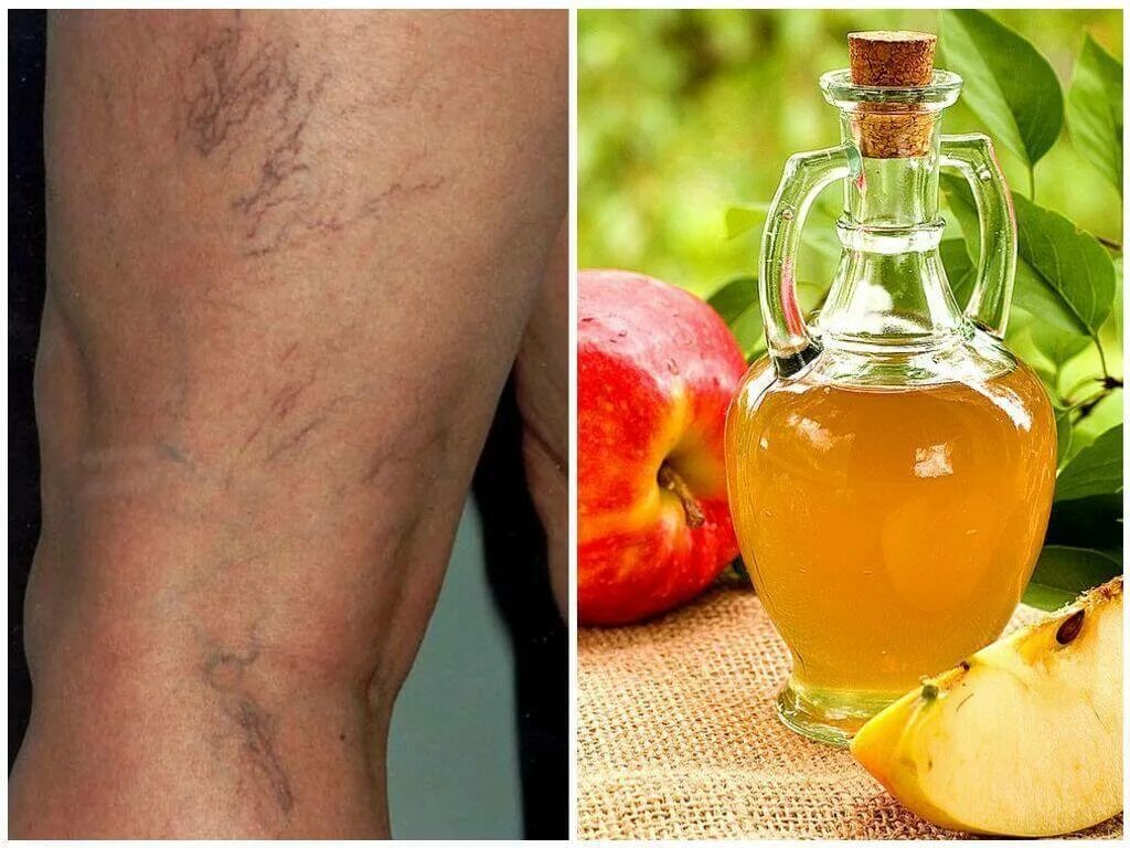 ретикулярный варикоз нижних. венозное расширение вен на ногах. ретикулярный варикоз ретикулярный. можно ли лечить варикоз. 1 стадия варикоза вен нижних конечностей.