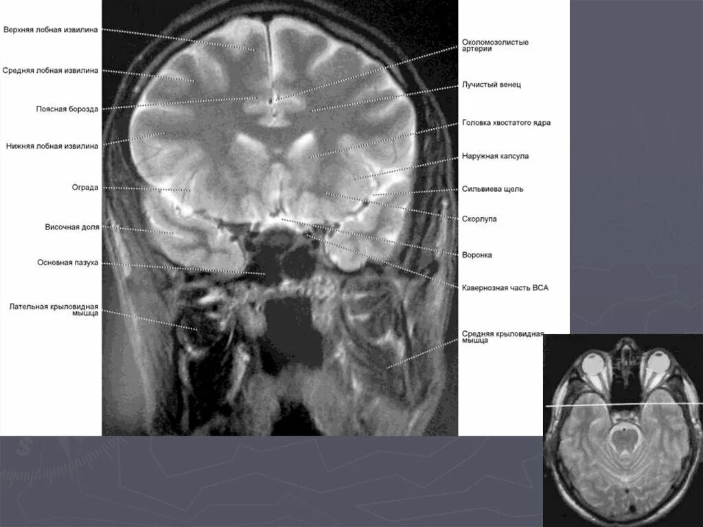 Сильвиева щель мрт. Сильвиева щель в головном мозге. Сильвиева борозда головного мозга. Арахноидальные кисты мостомозжечковых углов. Сильвиева борозда головного мозга.
