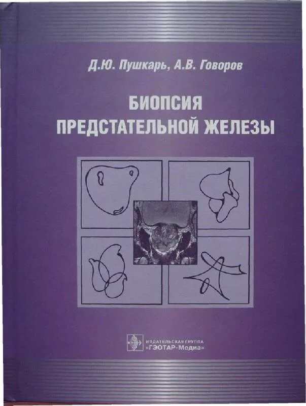 Как делается процедура биопсии простаты