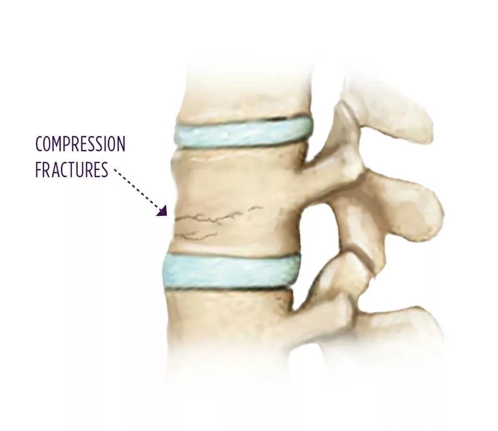 Трещина пациент. Osteoporotic vertebral Compression Fractures.