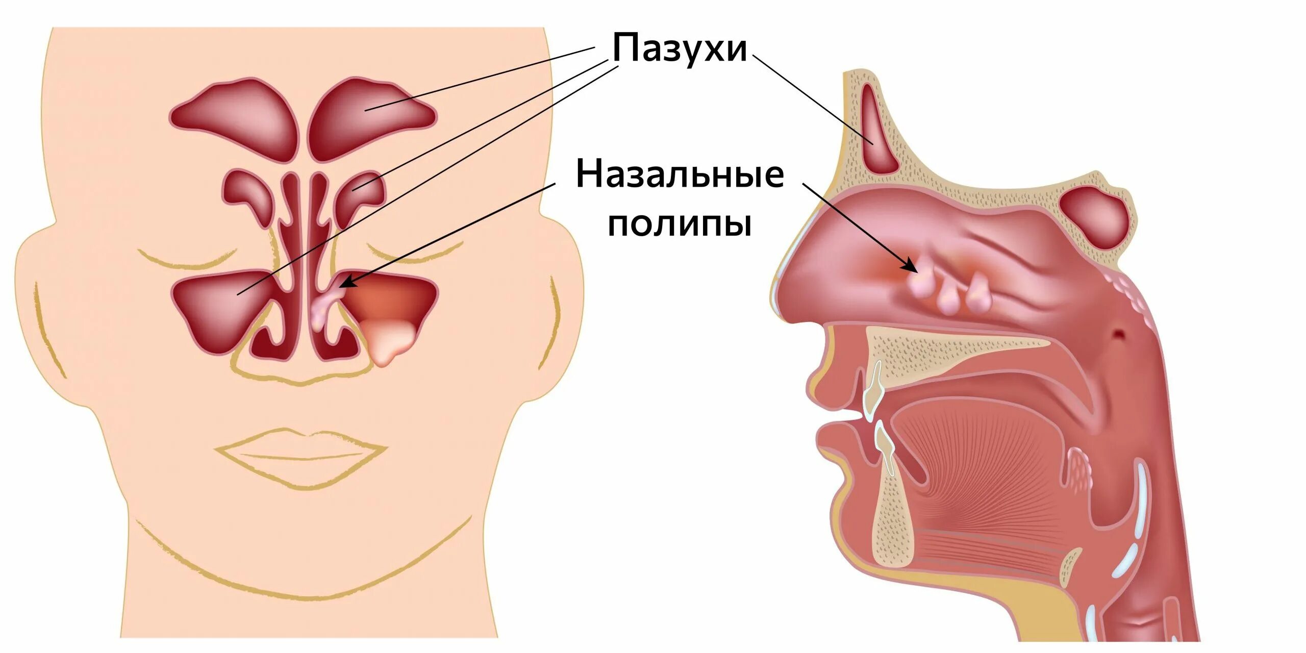 Почему горит нос. Полип в гайморовой пазухе. Полип верхнечелюстной пазухи.