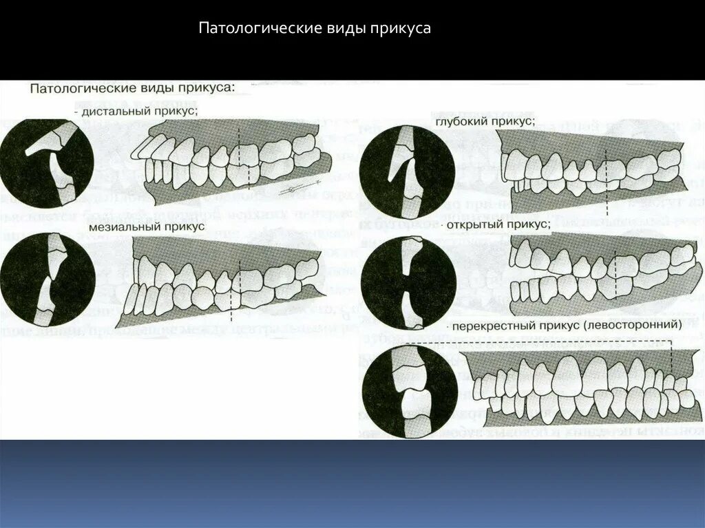 Патологический прикус