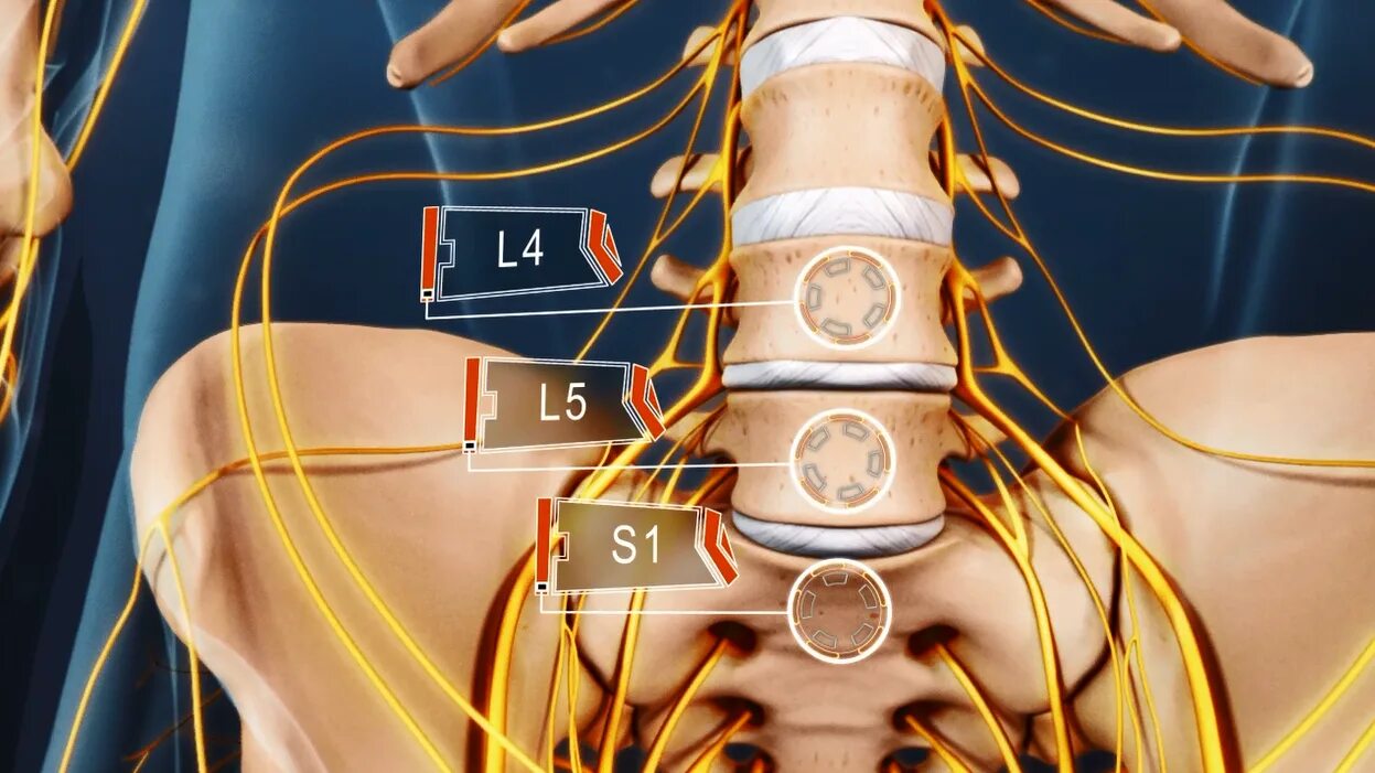 Корешковые нервы в пояснице. Диски l5-s1 в позвоночнике. Протрузия l3-l4 l4-l5. Межпозвоночный диск l5-s1.