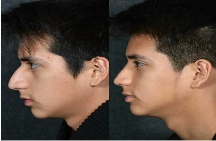 Мужчины после операции. До и после пластики носа мужчины. Пластическая операция на нос у мужчин. Пластическая операция носа до и после мужчины.