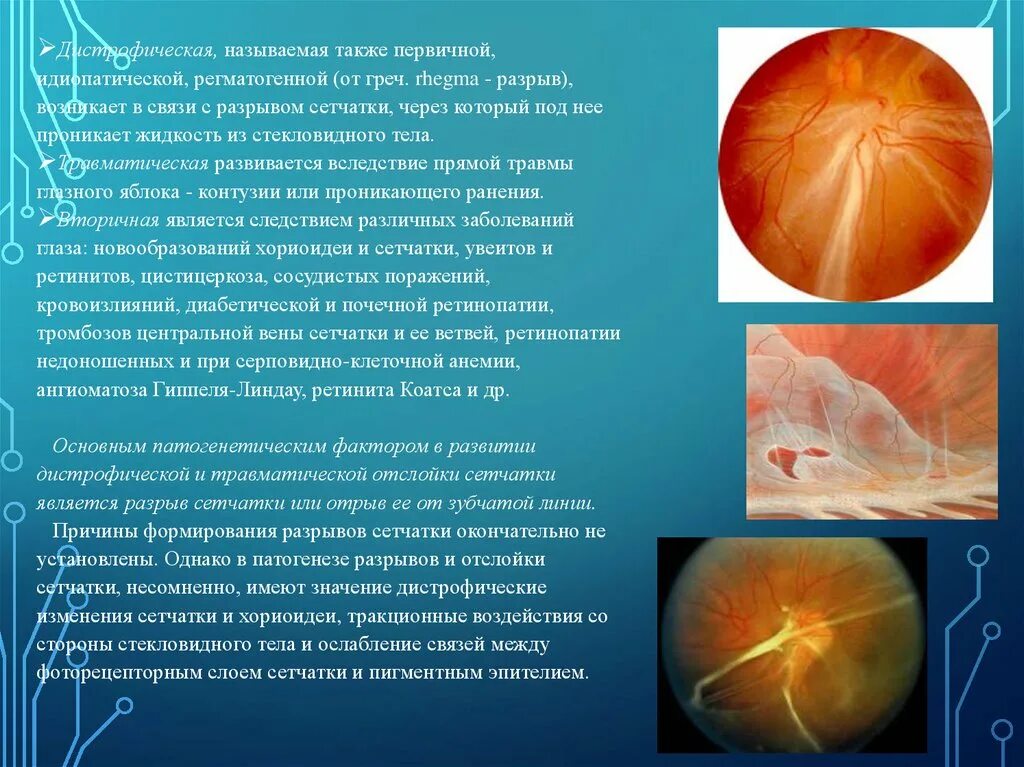 Инородное тело на сетчатке. Контузионное помутнение сетчатки. Жидкость в сетчатке