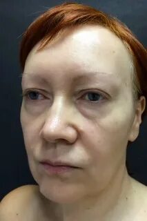 Почечные глаза