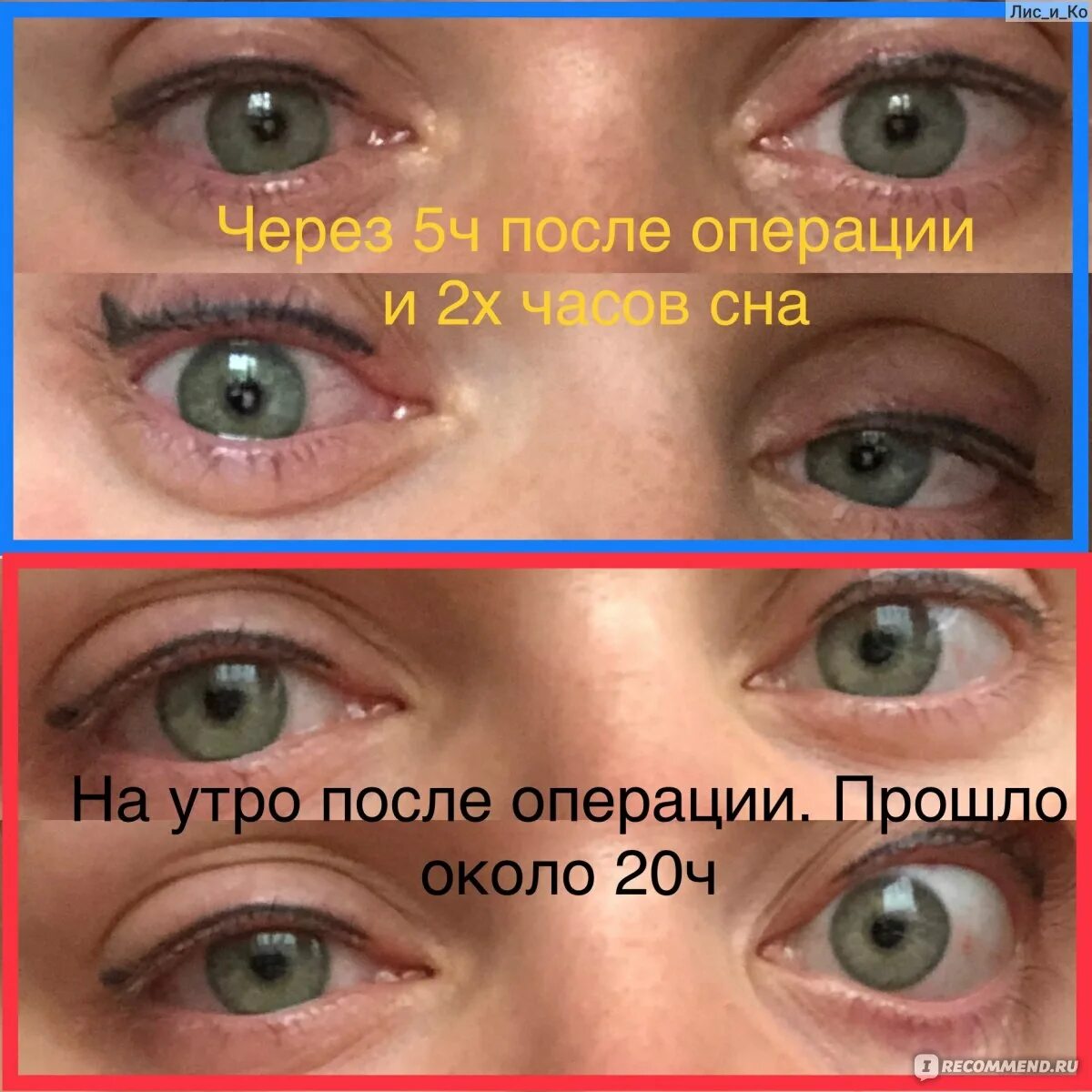 Глаза после лазерной коррекции. Глаза после лазерной коррекции зрения. До и после коррекции зрения.