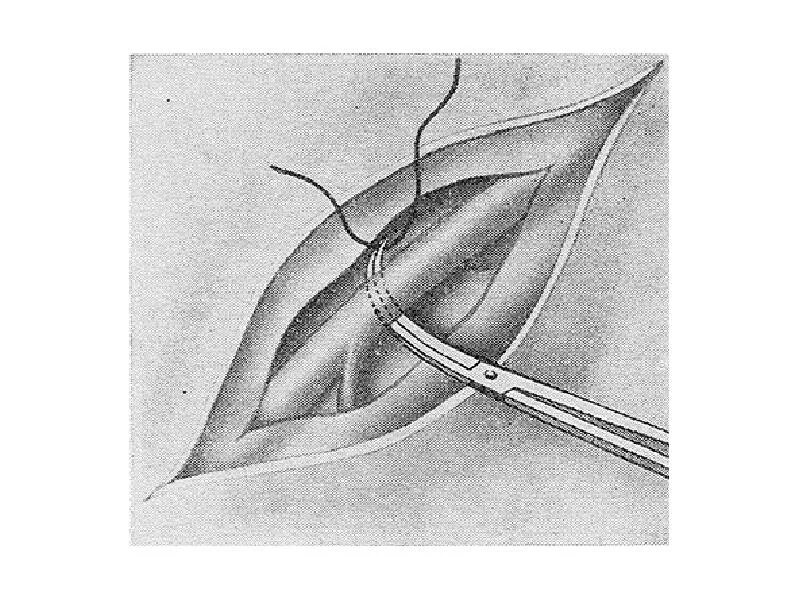 Сшивание нерва латынь. Лигирование сосуда в ране. Перевязка (лигирование) сосуда. Лигирование кровеносного сосуда в ране. Техника лигирования сосуда в ране.