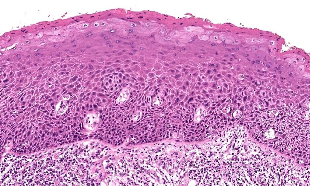 Неороговевающий рак матки. Плоскоклеточная папиллома кожи гистология. Плоскоклеточная папиллома микропрепарат. Плоскоклеточная папиллома кожи микропрепарат.
