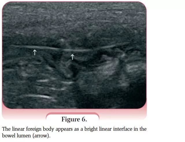 Кишечная непроходимость на УЗИ. Инвагинация кишки ультрасонография. Инородное тело в кишечнике на УЗИ. Линейное инородное тело на УЗИ.