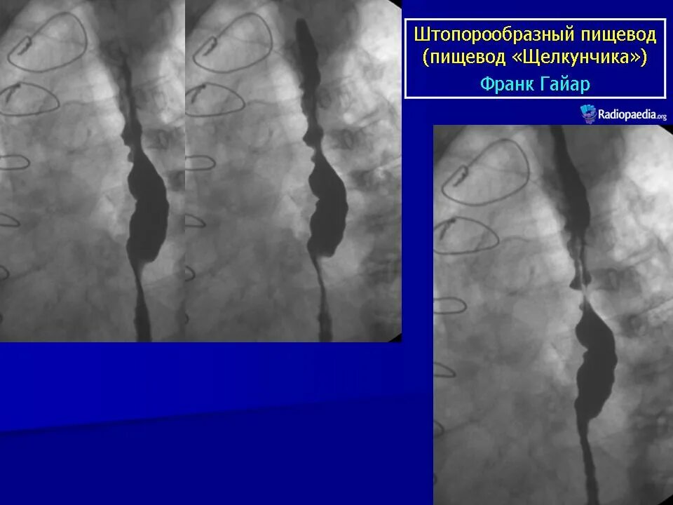 Пищевод шацкого. Пищевод Барретта рентген. Дивертикул пищевода рентген. Ахалазия и дивертикул пищевода.