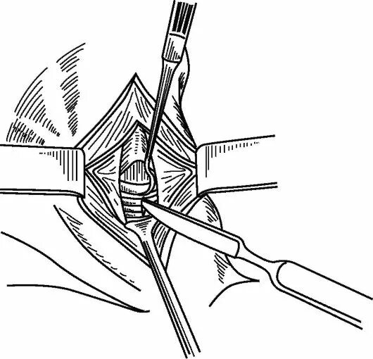 рассечение гортани.