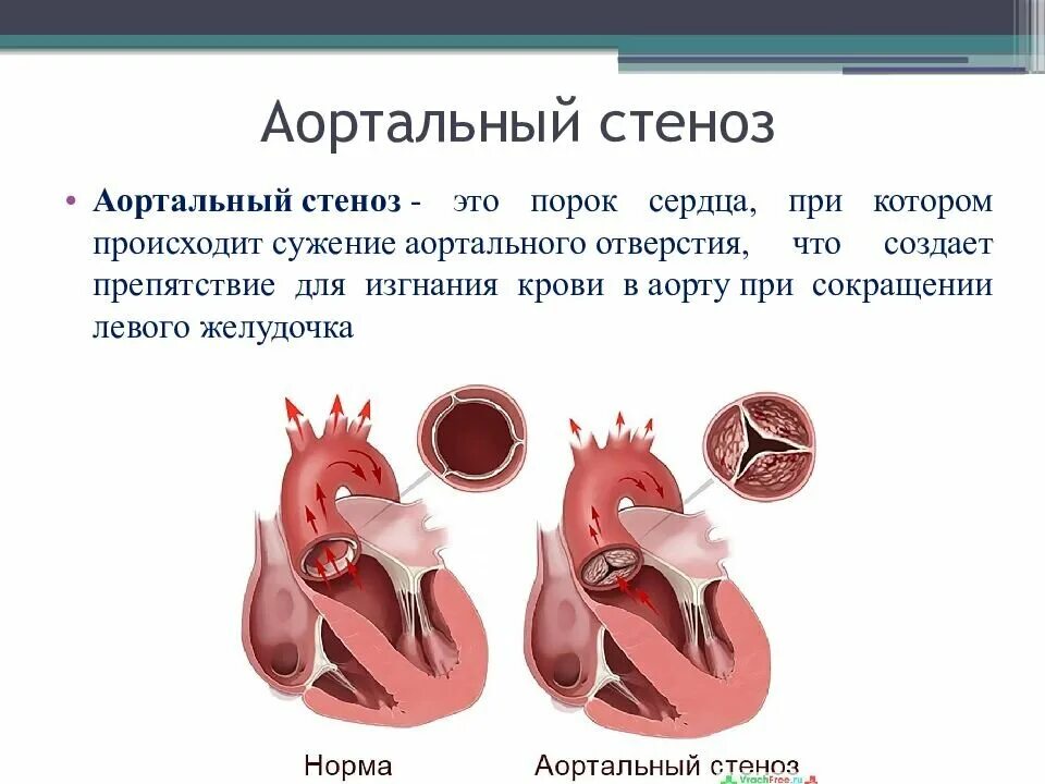 Аортальный стеноз что это такое