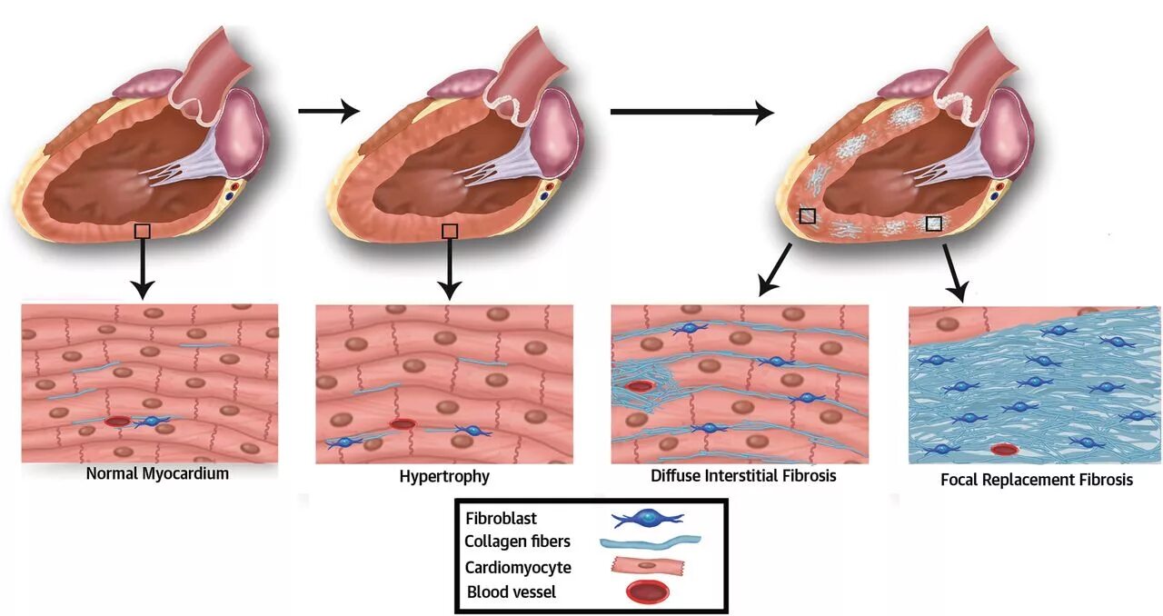 Лечение фиброза у мужчин. ЭКГ ИБС постинфарктный кардиосклероз. Атеросклеротический кардиосклероз патогенез. Диффузный атеросклеротический кардиосклероз. Атеросклеротический мелкоочаговый кардиосклероз.