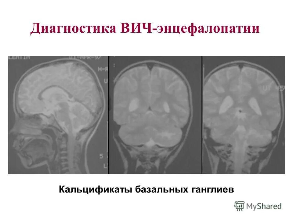 Энцефалопатия при вич инфекции. Спид ассоциированные инфекции. Вич деменция. Вич ассоциированная деменция презентация. Вич ассоциированная энцефалопатия кт.