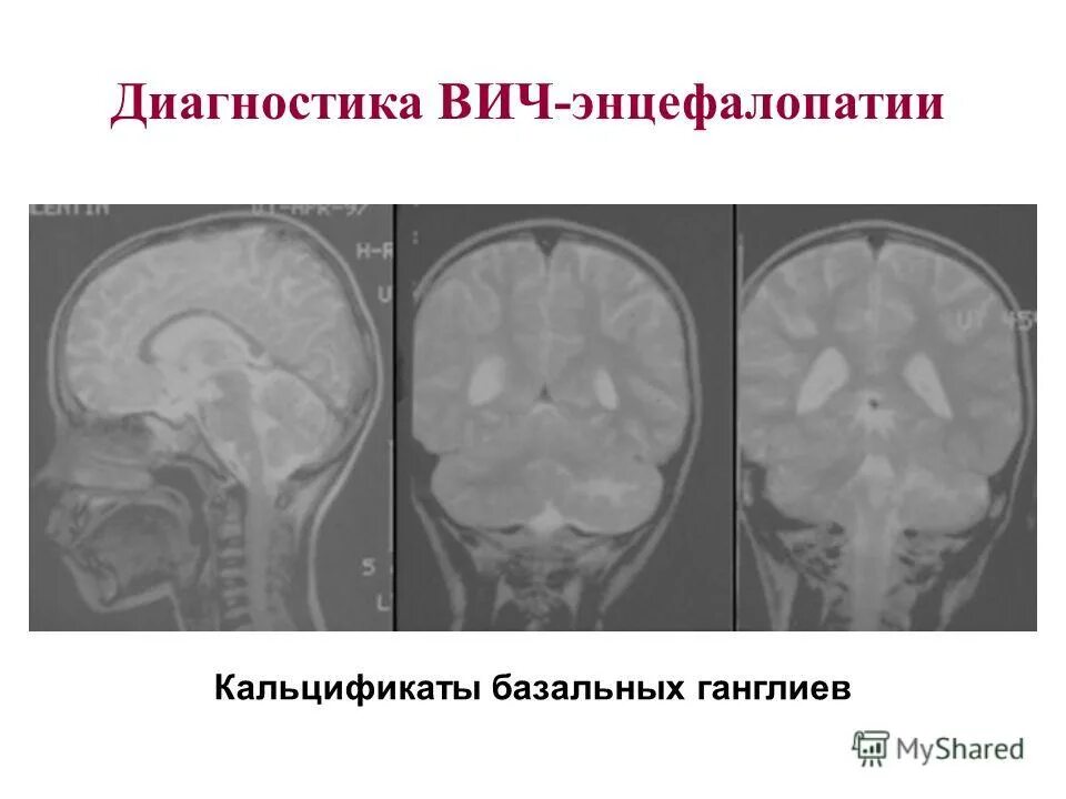 Вич энцефалопатия. ВИЧ ассоциированная энцефалопатия кт. ВИЧ ассоциированная энцефалопатия мрт. ВИЧ энцефалит головного мозга кт.