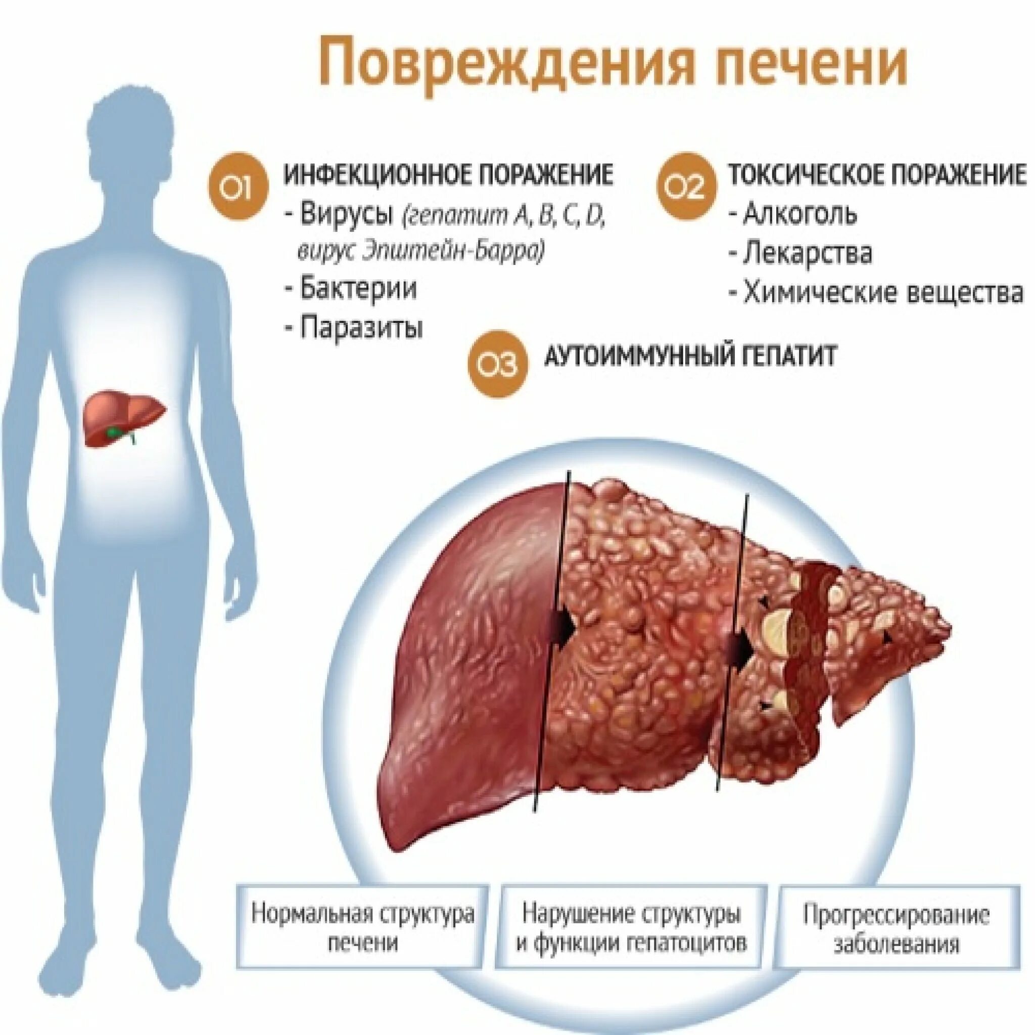 Гепатит сердце. Токсическое поражение печени.