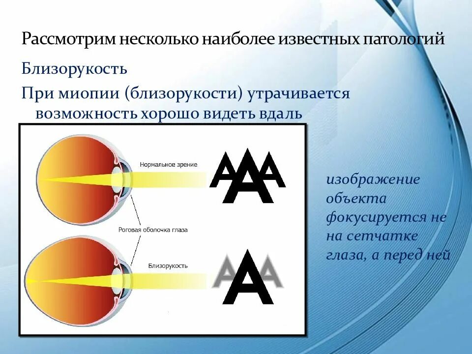 Слабая миопия глаза что. Миопия высшей степени. Высшая степень близорукости. Близорукость слабой степени. Близорукость высокой степени.