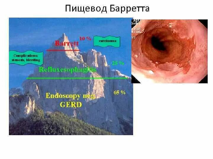 Пищевод Барретта эндоскопическая классификация. Метаплазия пищевода патанатомия. Пищевод Баррета эндоскопическая картина.