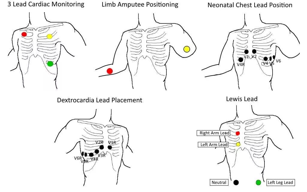 Электроды ЭКГ схема наложения электродов. Схема наложения электродов при декстрокардии. Наложение электродов Холтер. 3 Канальный Холтер наложение электродов. Соп экг
