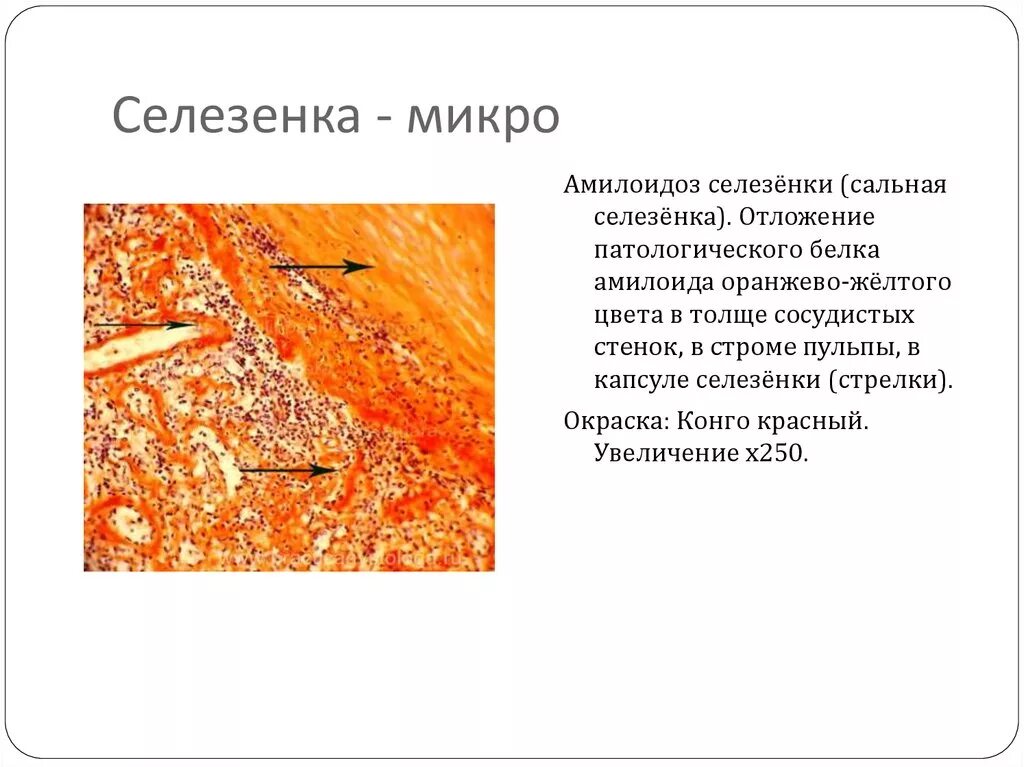 Саговая селезенка. Амилоидоз селезенки патанатомия. Амилоидоз селезенки саговая селезенка микропрепарат. САГОВЫЙ амилоидоз селезенки. Амилоидоз селезенки микропрепарат патанатомия.