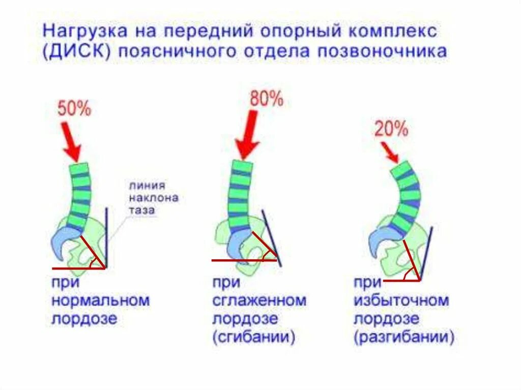 Нагрузка на поясницу. Нагрузка на межпозвоночный диск. Распределение нагрузки на позвоночник. Осевая нагрузка на позвоночник. Вертикальная нагрузка на позвоночник.