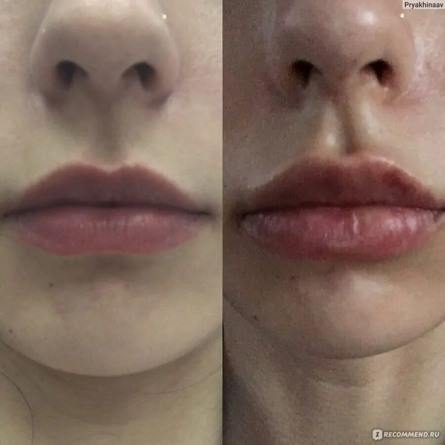 Ювидерм губы до и после фото Lip Injections Millburn, NJ Somalaser