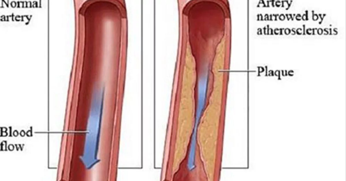 Стеноз просвета сосудов норма. Сужение просвета сосуда (стеноз). Почему сужаются сосуды