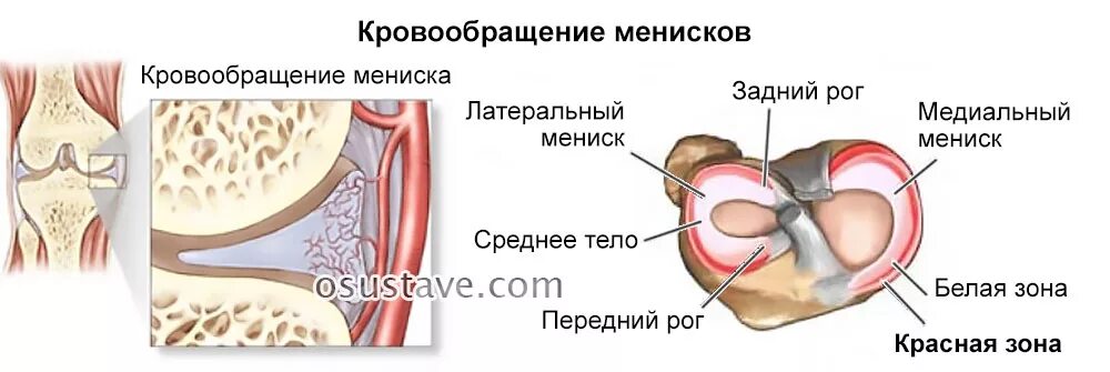 Разрыв медиального мениска. Медиальный мениск коленного сустава. Резекция коленного сустава при разрыве мениска. Растяжение мениска сустава. Повреждения мениска коленного сустава как лечить