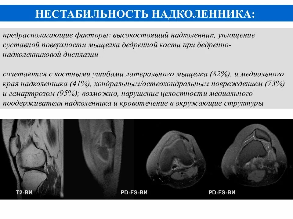 Латерализация надколенника. Подвывих надколенника мрт. Вывих надколенника рентгенограммы. Подвывих коленного сустава мрт. Латеральная дислокация надколенника.