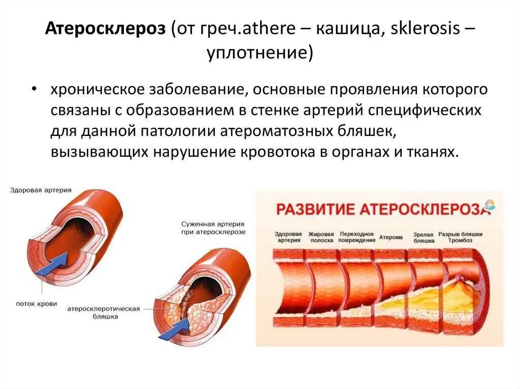 Уровень поражения стенки сосудов при атеросклеротической болезни. Развитию атеросклеротических поражений сосудов способствуют. Повреждение стенок сосудов, атеросклероз;. Причины формирования атеросклеротической бляшки. Хроническое заболевание сосудов